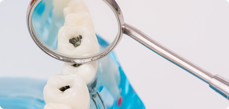 むし歯
